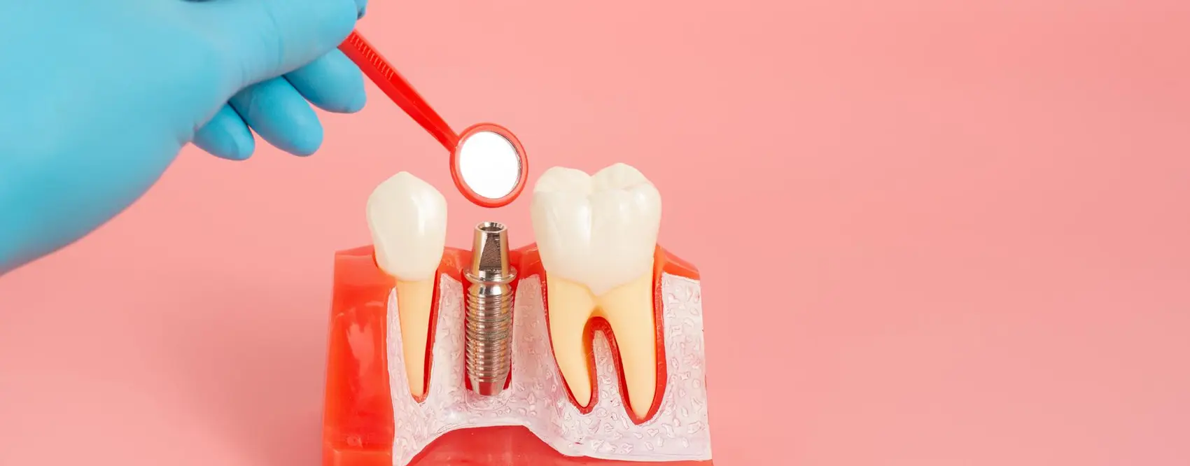 İmplant Tedavisi